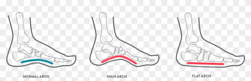 A Kids Foot Health Diagram Illustrating Arch Position - Foot Diagram ...
