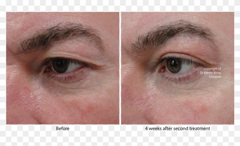 Before / After - Plexr Results, HD Png Download - 842x457(#1191031 ...