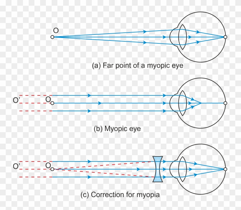 Hypermetropia Or Far Sightedness Far Point And Near Point Of Myopic Eye Hd Png Download 747x651 Pngfind Hypermetropia Or Far Sightedness Far Point And Near Point Of Myopic Eye Hd Png Download 747x651 Pngfind