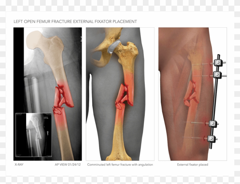 Left Femur Fracture With Surgical Fixation Stock Photo My Xxx Hot Girl