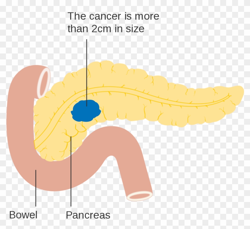 Symptoms Of Stage 4 Pancreatic Cancer