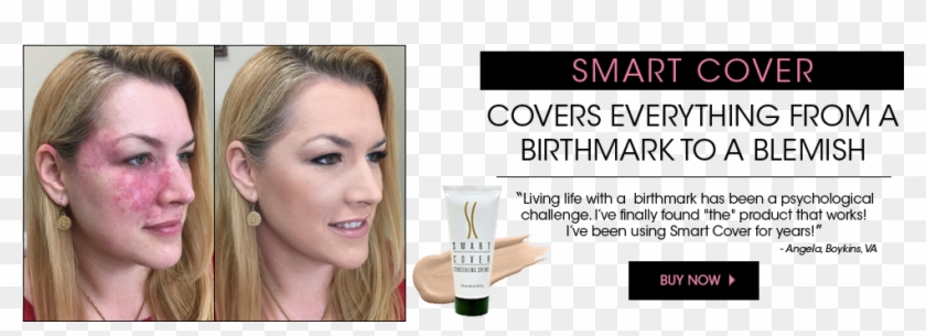 best makeup to cover acne